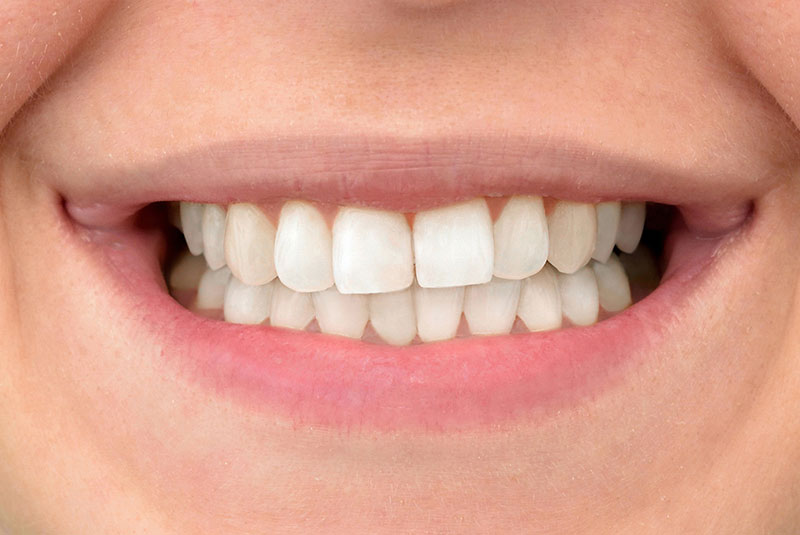 close up of before and after dental procedure