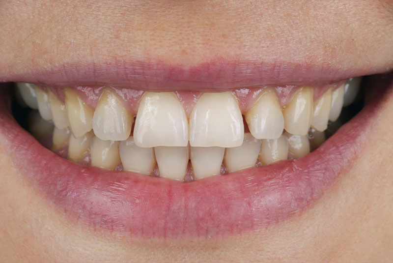 close up of before and after dental procedure