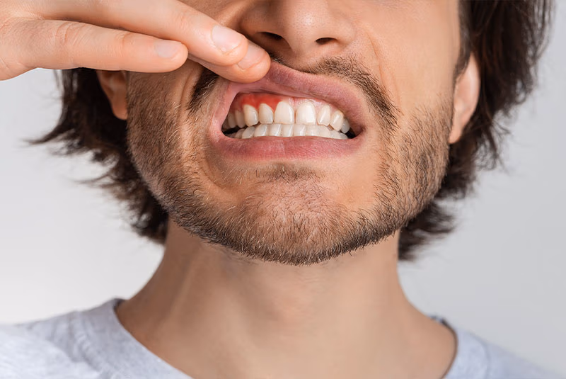 Gum disease
