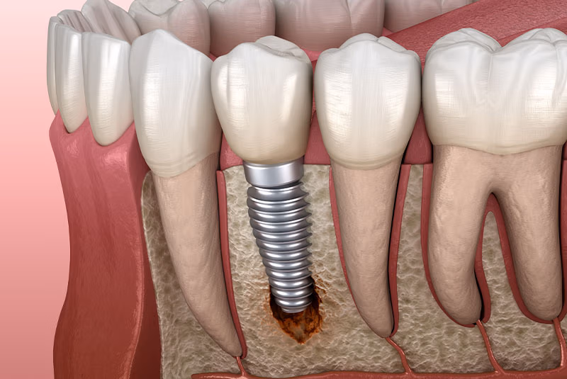 peri-Implantitis