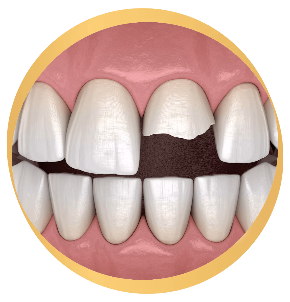Broken tooth