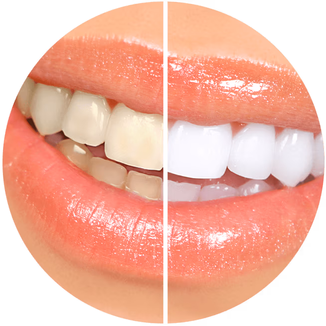before and after results of teeth whitening