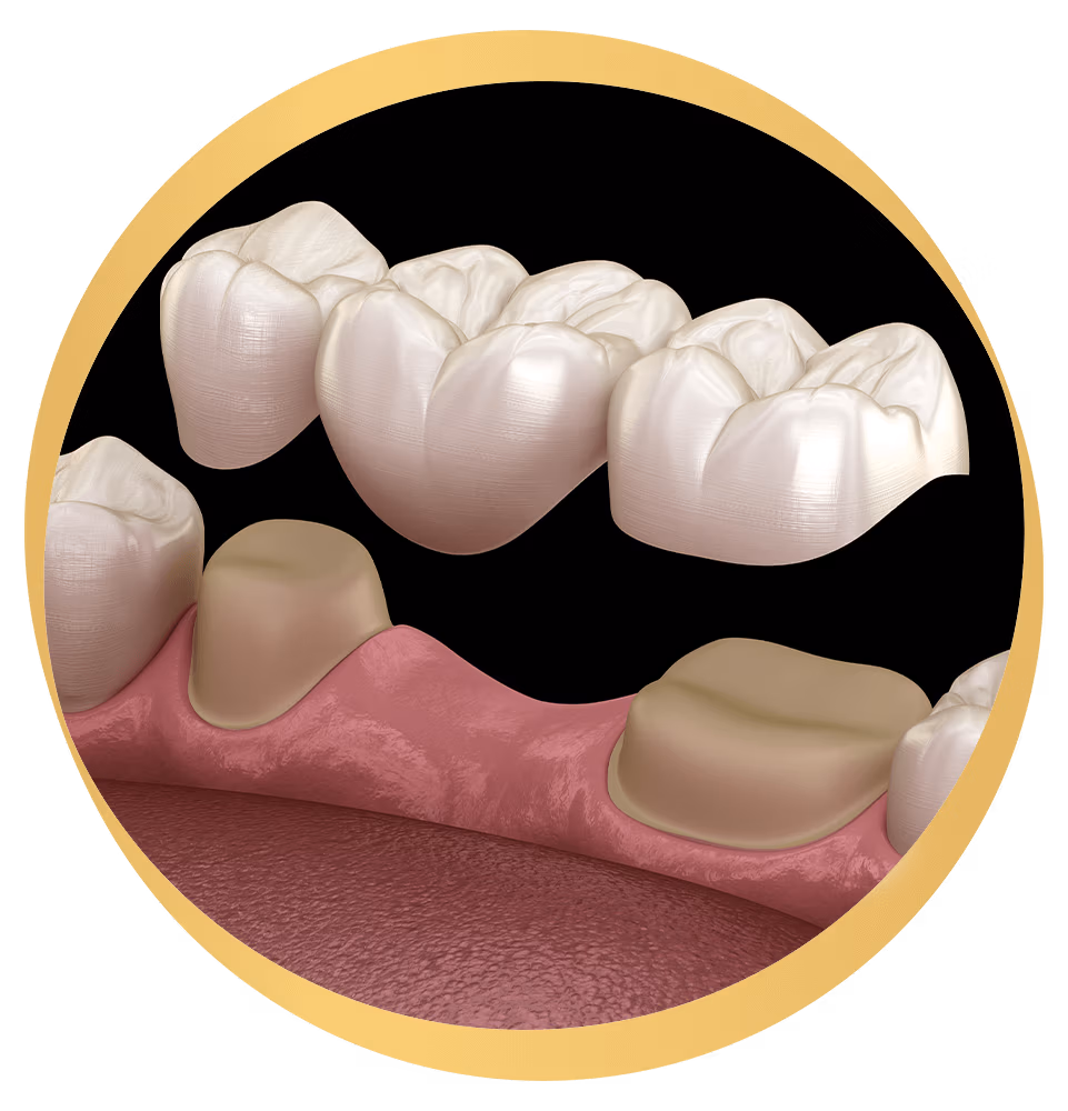 Dental Bridge
