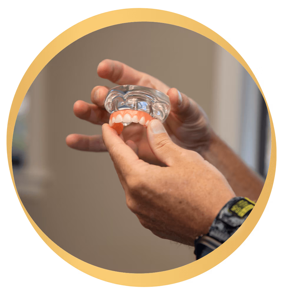model of full arch implants