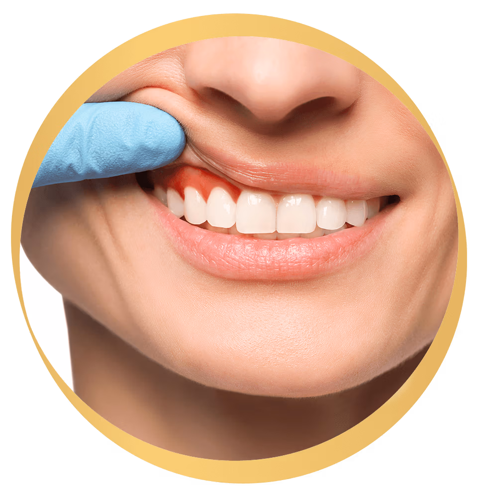 Gum Disease