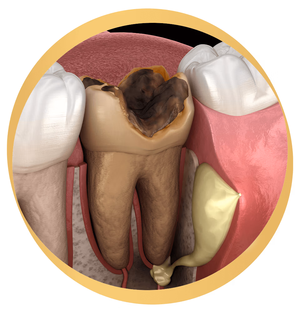 Tooth abscess