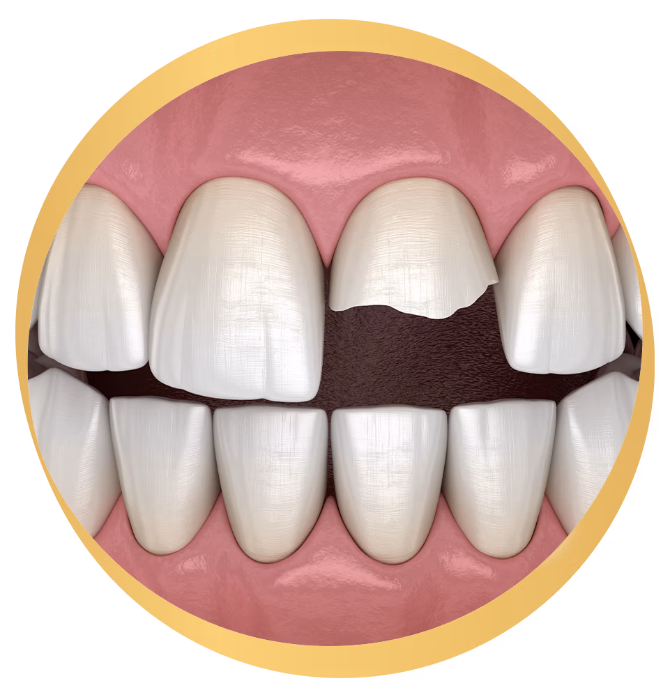Broken tooth